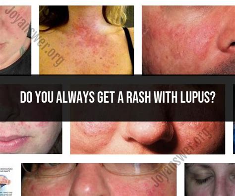 Lupus Rash: Understanding Symptoms and Variations - JoyAnswer.org