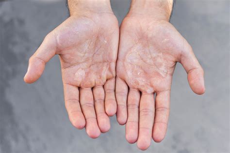 cara mengatasi telapak tangan dan kaki berkeringat