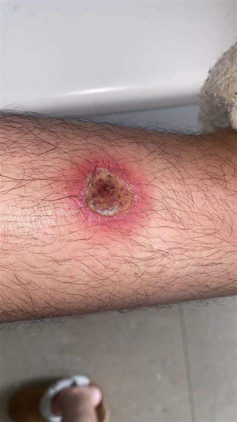 evolution   infected burn rmedicalgore
