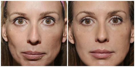 More amazing before and afters of Sculptra. Photos courtesy of Dr