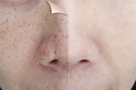 What Causes Light Brown Patches On Skin | Americanwarmoms.org
