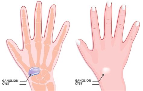 ganglion cyst   wrist