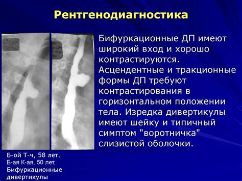 Дивертикулы пищевода - презентация онлайн