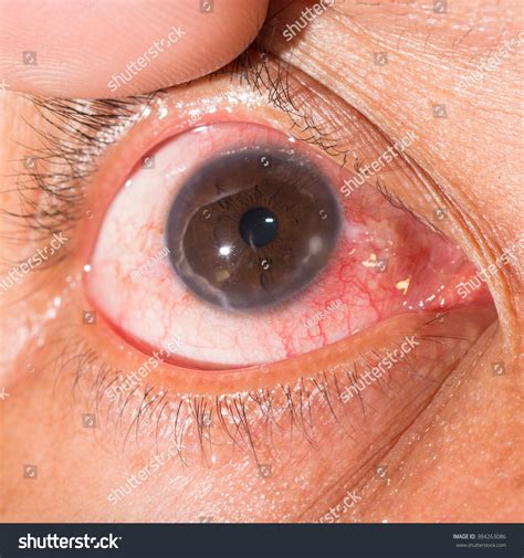 Marginal Keratitis
