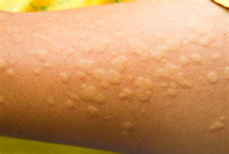 Orticaria: cos'è, cause e sintomi ! DIABASI®