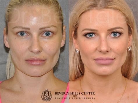 Profound RF/Skin Tightening – Before & Afters | Beverly Hills Center