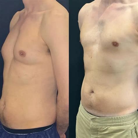 CoolSculpting Before and After - Before After Journey
