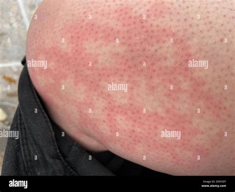 Mottled skin woman hi-res stock photography and images - Alamy