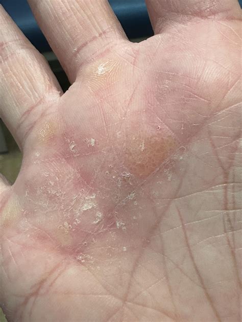 acute vesiculobullous hand eczema dyshidrotic eczema