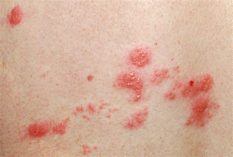 6 Home Remedies for Shingles & How to Use Them - eMediHealth