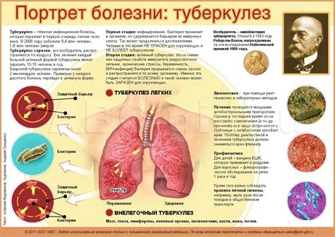 Туберкулёз | lemur59.ru