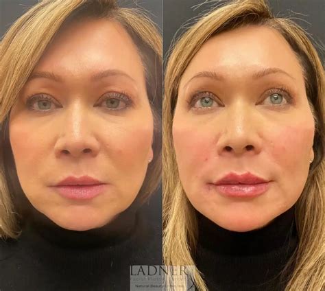 lip line fillers 2