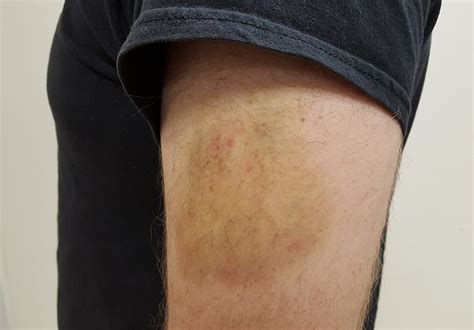 how to fix hematoma