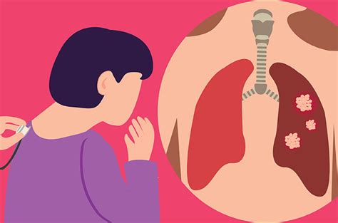 Ini 4 Kelompok Orang yang Berisiko Terkena Kanker Paru-Paru