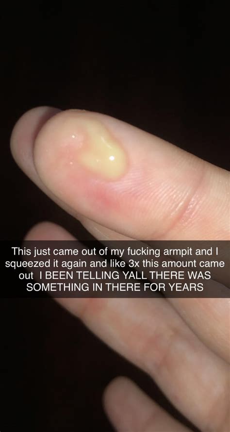 Armpit cyst popped after years, once again I forgot to record it and ...