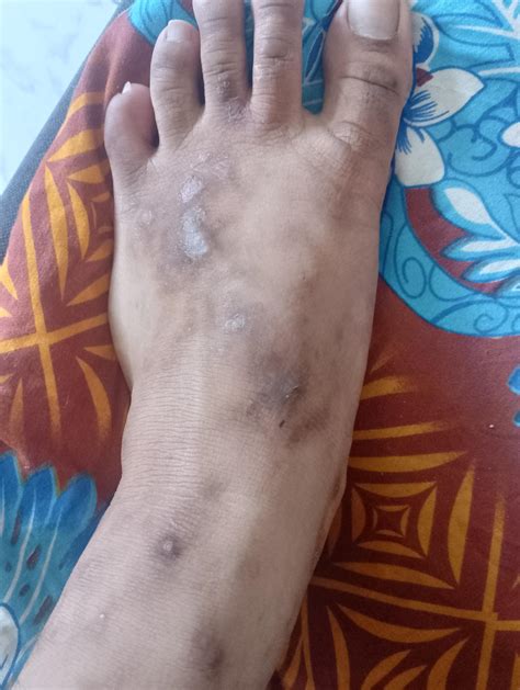 Help! : r/Folliculitis