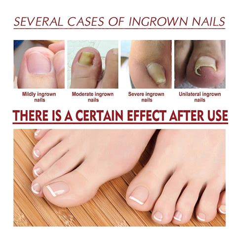10ml Anti Paronychia Relief Oil for Toenails - Soften, Strengthen, and