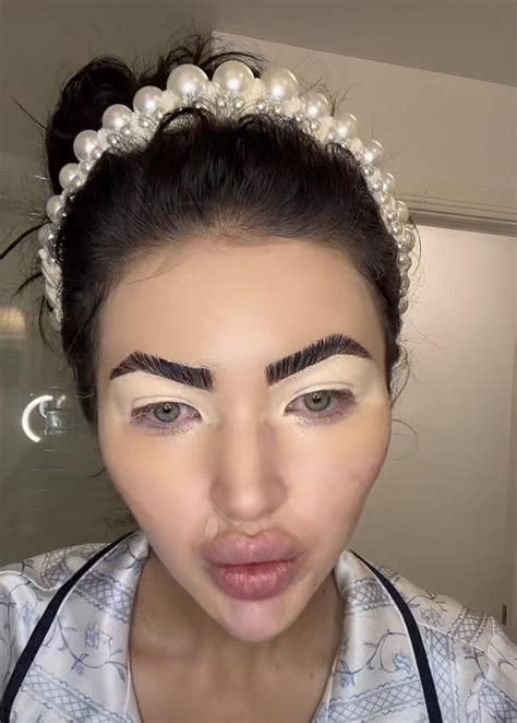 The biggest transformation : r/Botchedsurgeries