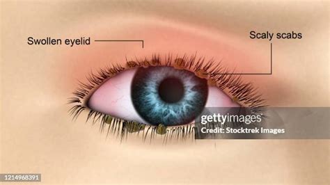 swollen eyelid   premium high res pictures getty images