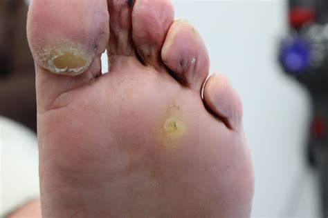 plantar warts duct tape