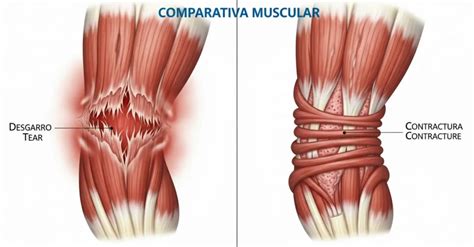 Qué Es Un Desgarro Muscular Y Cómo Se Diferencia De Una Contractura