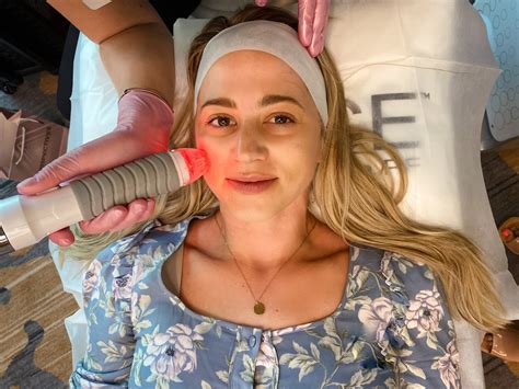 My Experience with Vivace Microneedling - The Road Les Traveled