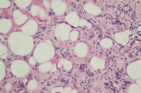 Dermpath Made Simple - Neoplastic: Dermatofibroma