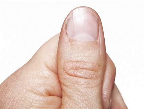 Nail Pitting: Causes, Treatment, and More