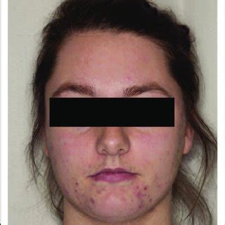 Cushing's syndrome manifestations on a 10-year old. (a) moon face,...