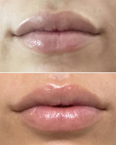 Patient 148023333 | Lip Flip Before & After Photos | EuroPhoria