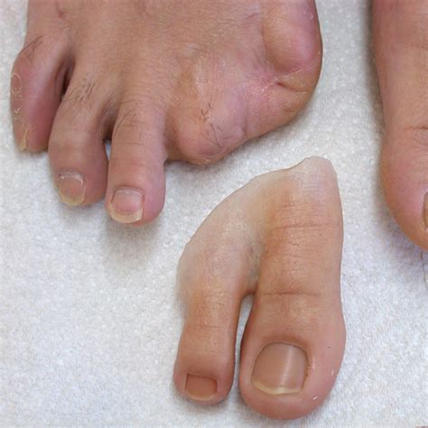 Toes - Aesthetic Prosthetics Inc®