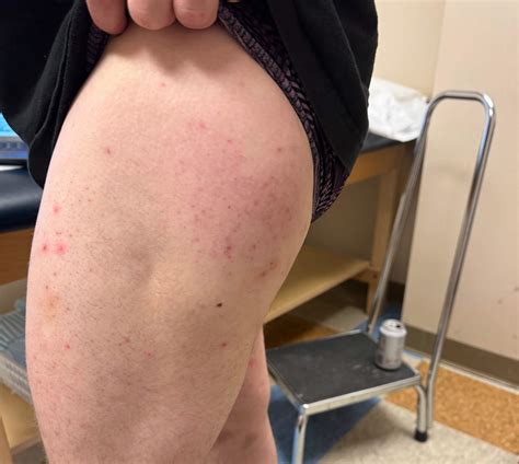 OrthoDx: Morel-Lavallee Lesion - Clinical Advisor