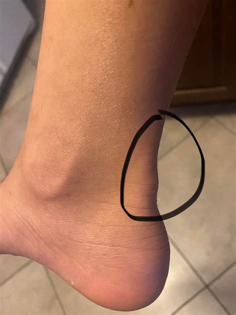 What causes possible recurring athletes foot? : DermatologyQuestions