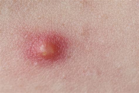 pustules