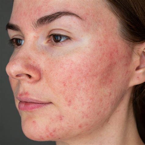 buy rosacea treatment   chemist