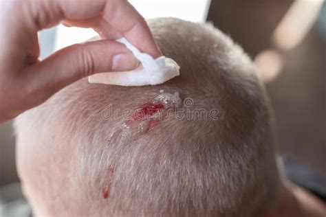 Injury To the Scalp. Blood Leaks from a Chopped Wound on the Head Stock ...