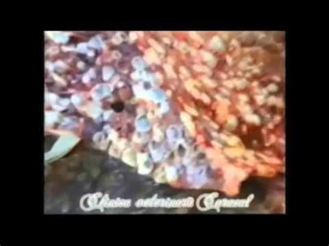 Альвеолярный эхинококкоз лекгих - YouTube