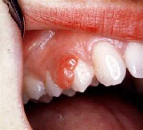 pyogenic granuloma teeth