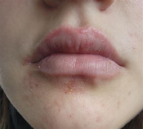 Itchy Lips How To Treat at Jamie Gibb blog