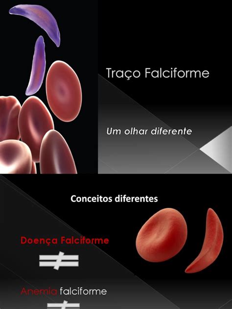 Traço Falciforme O Que É - Traço Falciforme Outubro 2013 | Doença Falciforme | Anemia