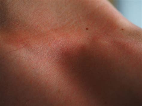 Alergia al sol – Cooperativa Farmacéutica de Tenerife COFARTE