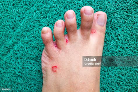 tinea pedis fungal infection  athletes foot  red scaly rash