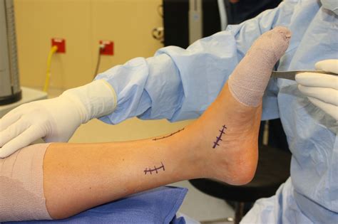anterior tibialis tendon surgery recovery