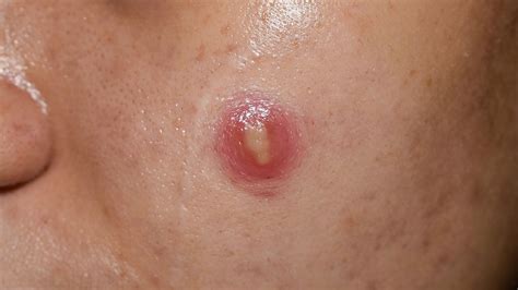 Acne Vulgaris Causes, Pathogenesis, Influencing Factors,, 40% OFF