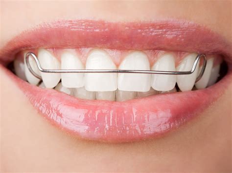 complete guide  wearing retainers