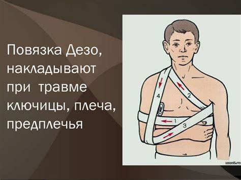 Повязки, накладываемые на грудную клетку - презентация онлайн