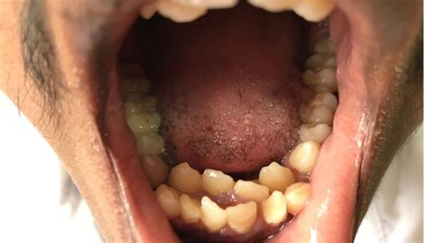 HYPERDONTIA – Medical Centric