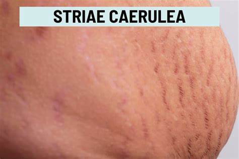 Types of Stretch Marks (with Pictures)