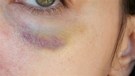 eye botox skin beauty