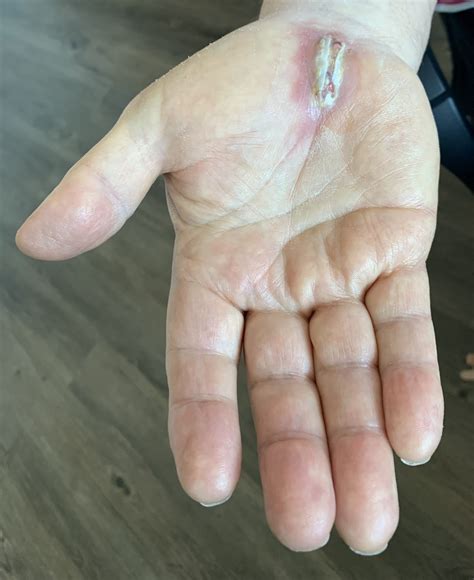 Urgent Warning: Are Your Weeping Wounds Infected?